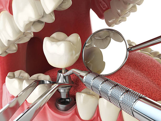 Best Emergency Root Canal Treatment in Cameron, MO